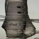 What to Do When an Arm is Bent? 3D Printing Achieves a "Personalized Custom" Solution