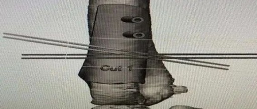 What to Do When an Arm is Bent? 3D Printing Achieves a "Personalized Custom" Solution