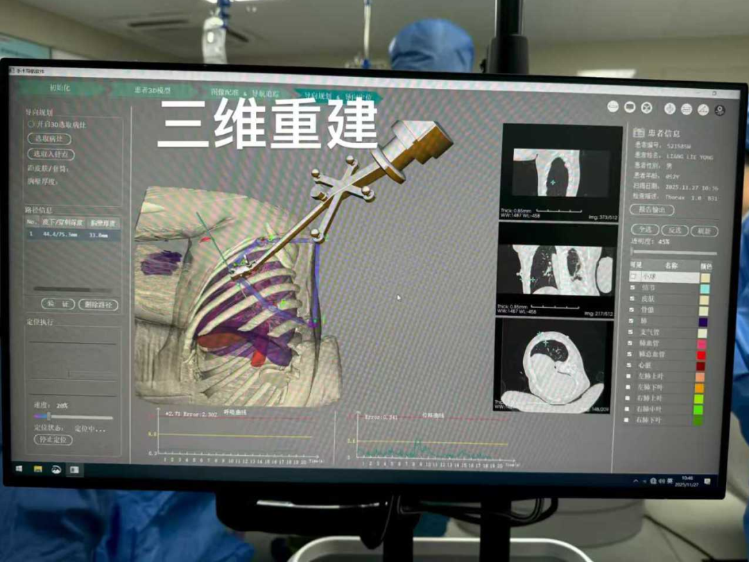 When AI Robots Meet Cryoablation: Lung Nodules Precisely Frozen with a Single Injection!