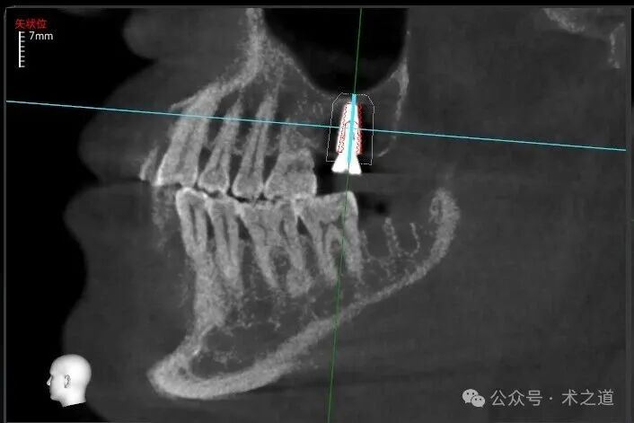 Advantages of the 'ZhiZhi π' Dental Implant Robot-Assisted Implantation Technology in the Maxillary Molar Region